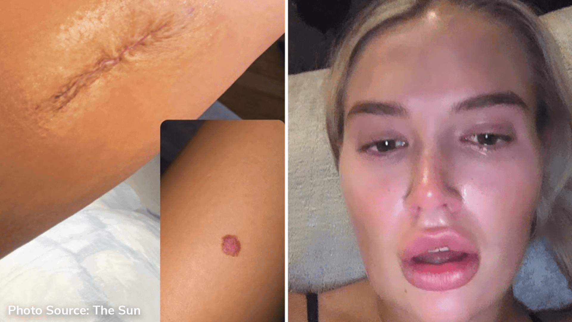 Molly-Mae Hague’s cancer scare surgery is next week