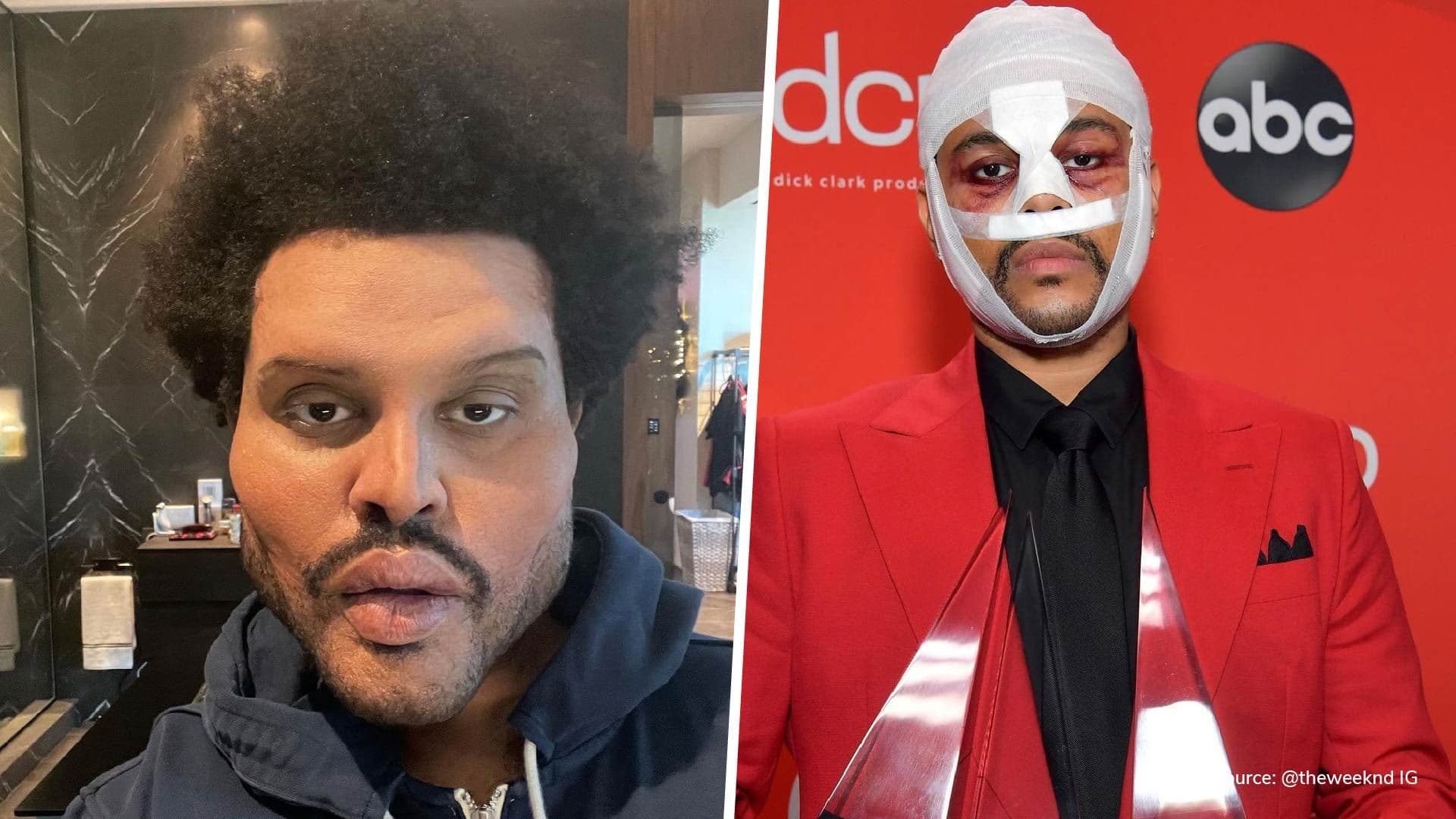 The Weeknd trades in bandages for botox in latest music video look