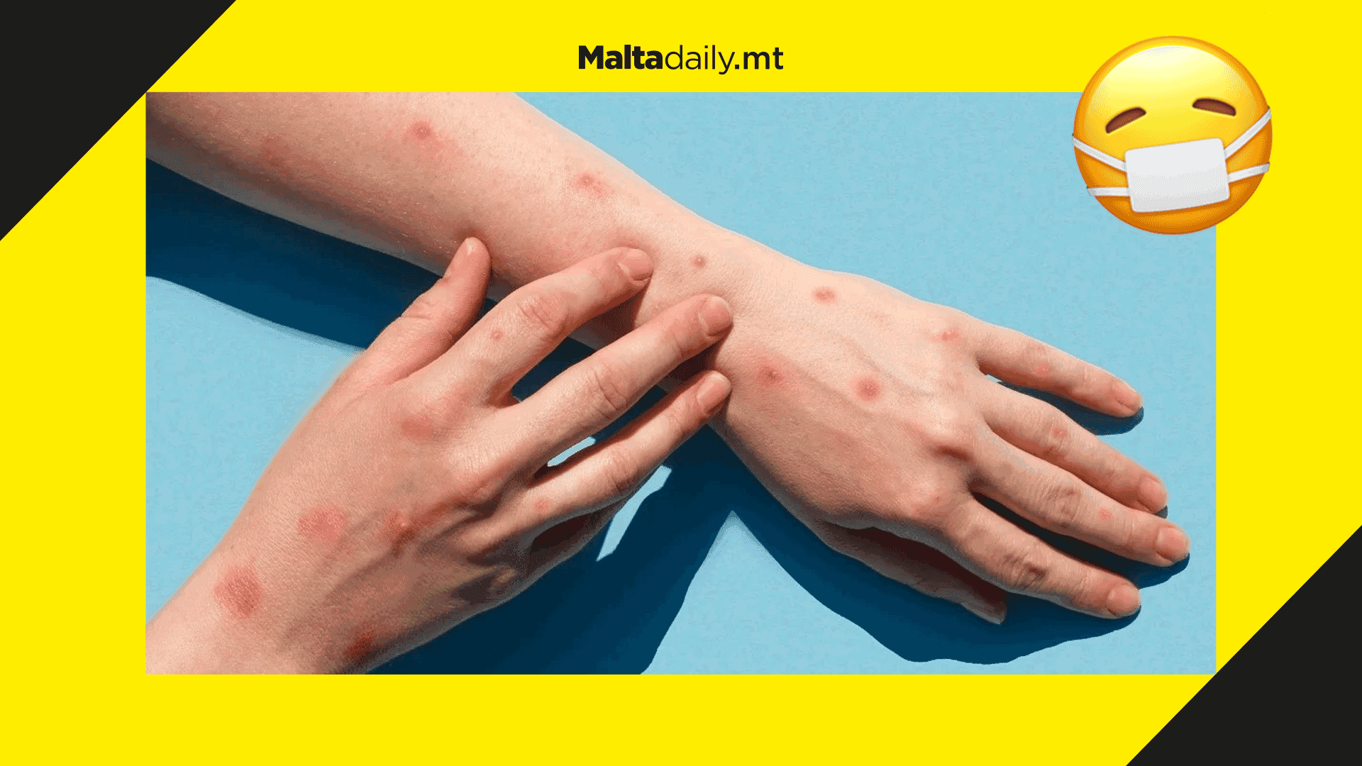 3 active cases of monkeypox found in Malta