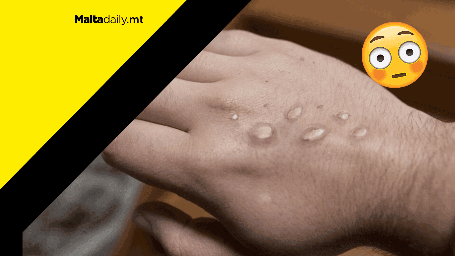 14 active cases of Monkeypox currently in Malta