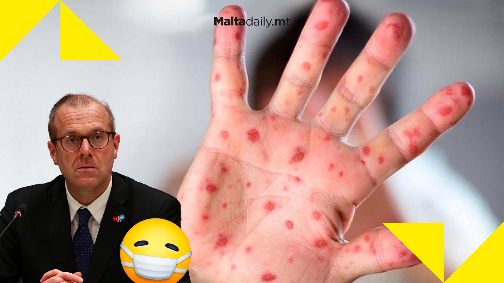 Monkeypox cases in Europe tripled in 2 weeks as WHO calls for action