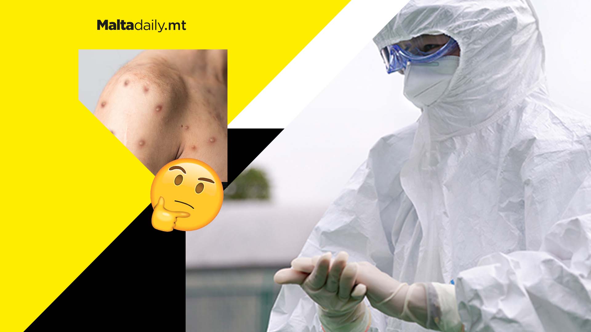 Over 700 monkeypox cases globally but no fatalities