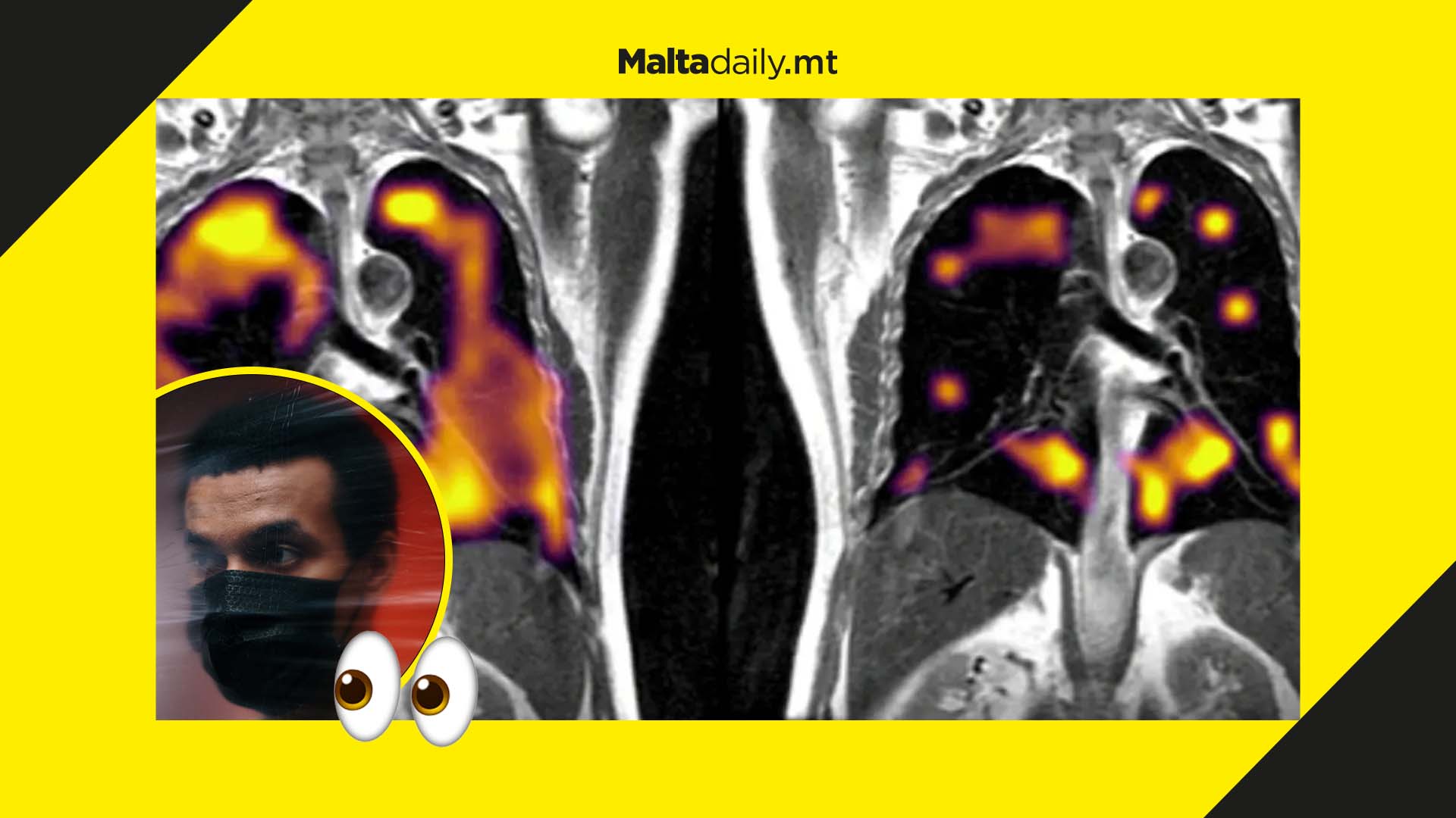 Persons recovering from long-term COVID symptoms found to have suffered lung problems