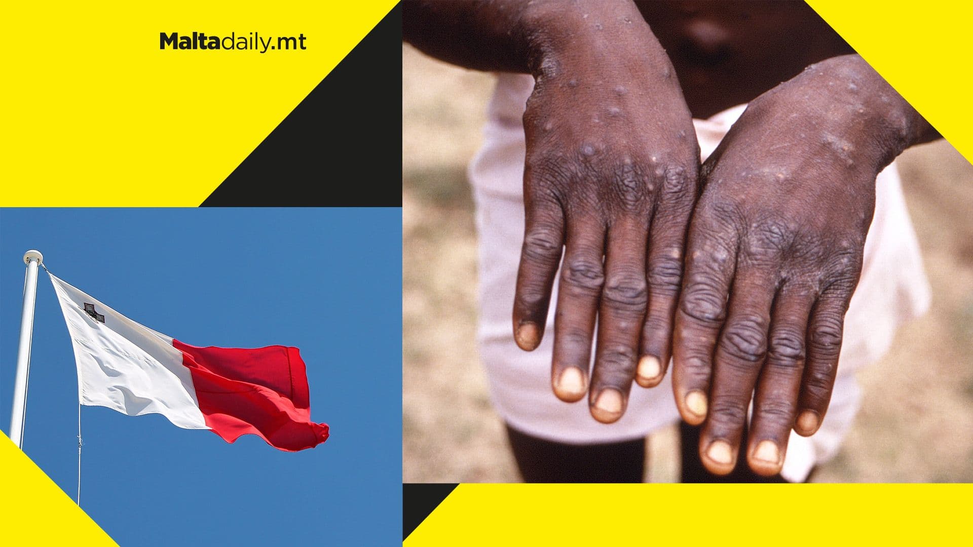 First case of Monkeypox detected in Malta