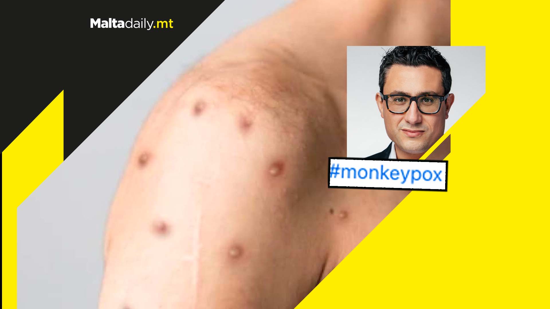 Here is what a Maltese doctor had to say about monkeypox