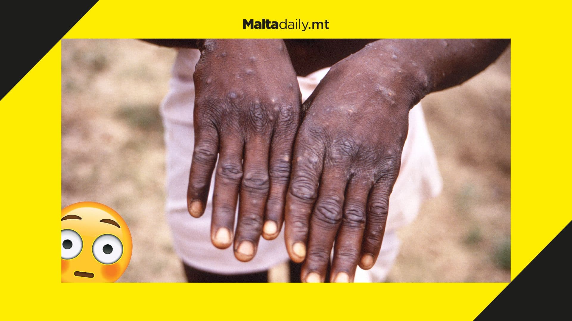 Monkeypox could accelerate in Europe as cases found in multiple countries, WHO warns