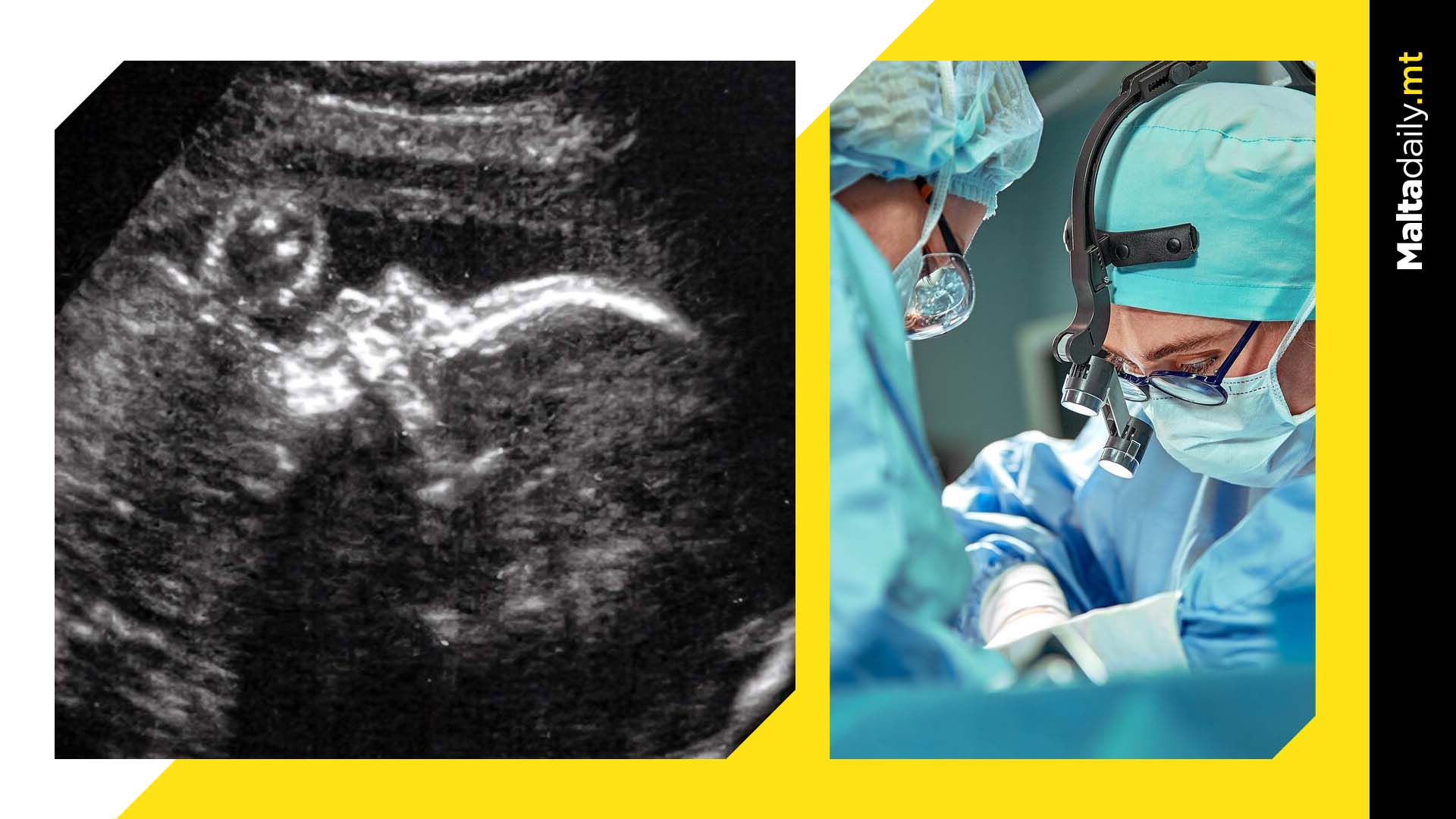 First brain surgery on baby in womb a success