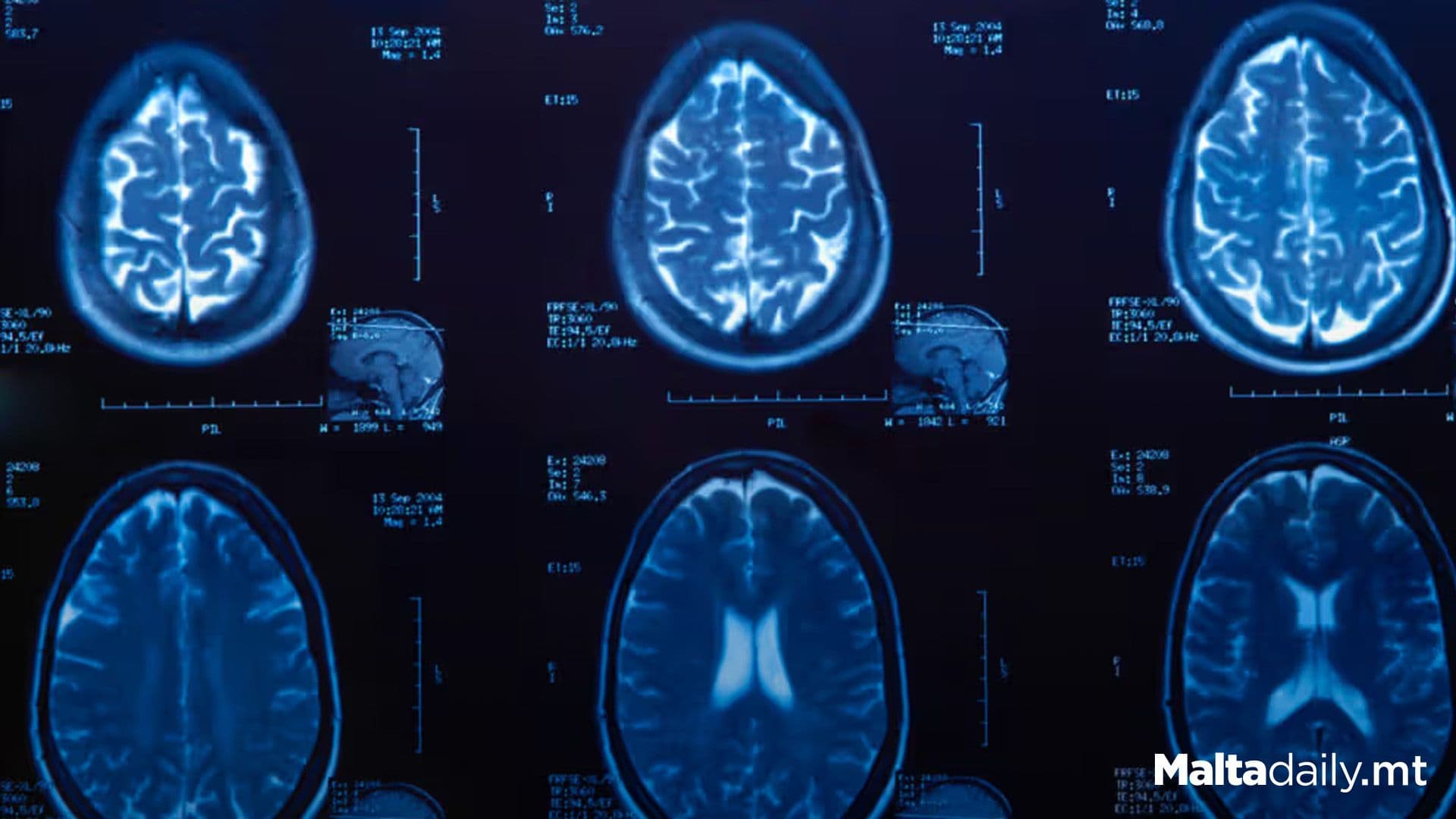 2,058 Parkinson`s Patients Benefit From New Medication Access