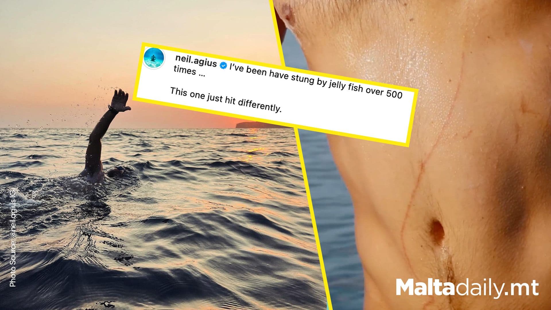 Neil Agius Suffers Worst Jellyfish Sting, Suspects Box Jellyfish