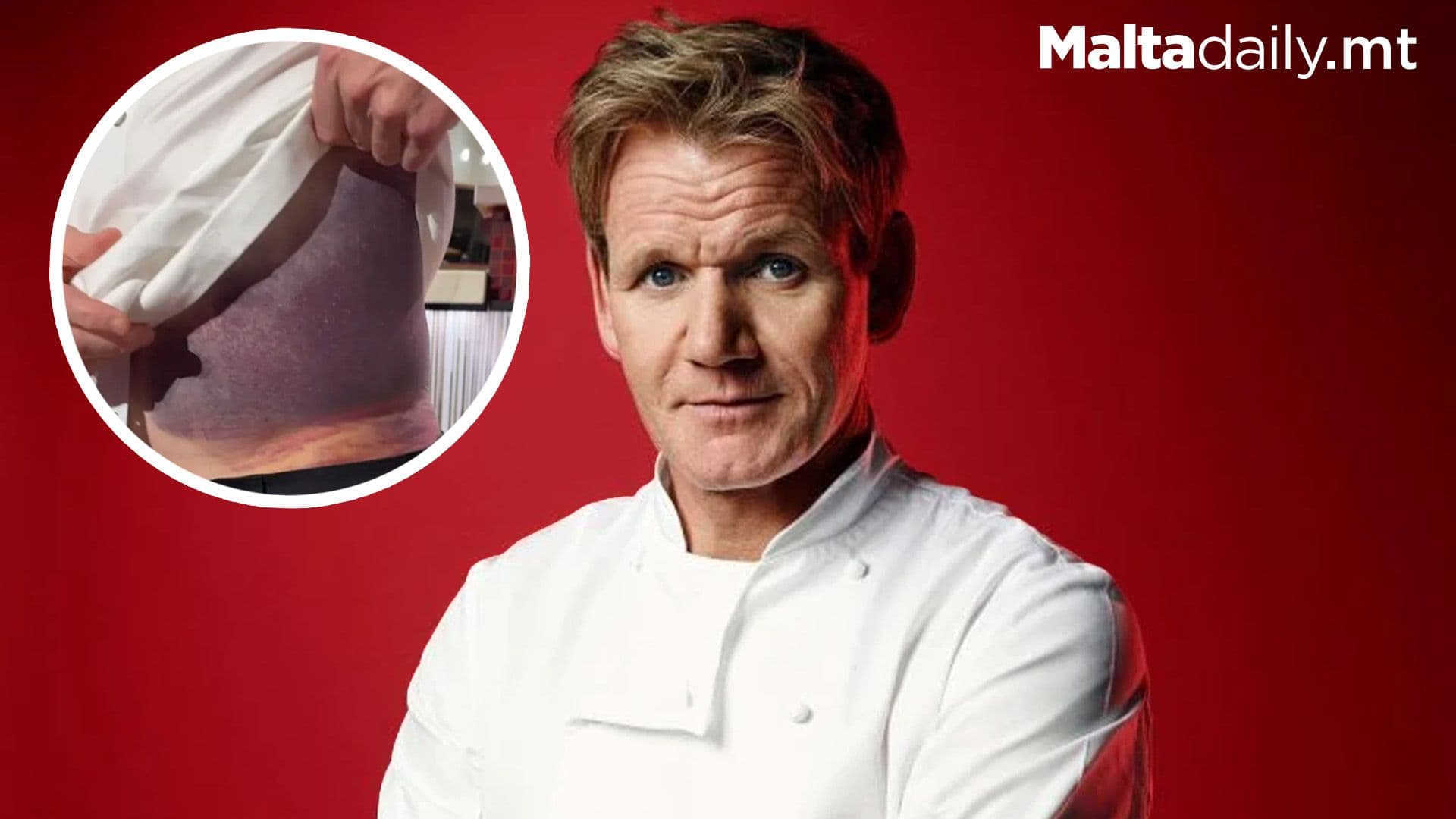 Gordon Ramsey Shows off Scary Bruise from Bike Accident