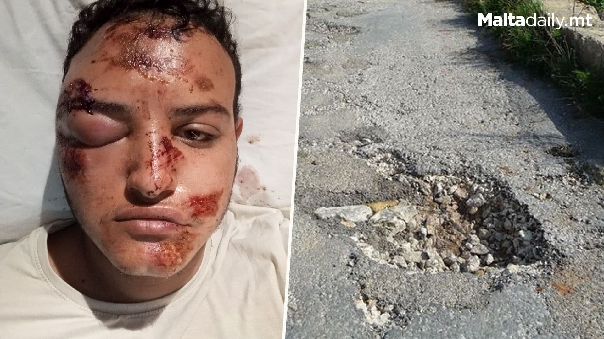 Cyclist Raises Awareness After Injury Due To Pothole