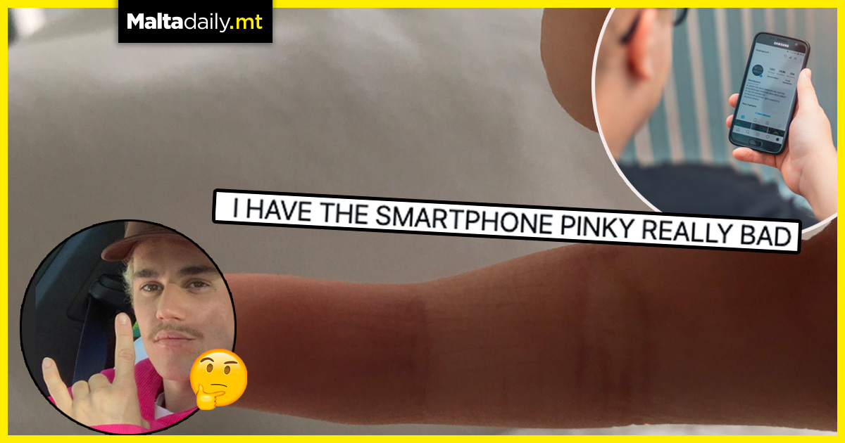 Social media users report ‘smartphone pinky’ as fingers bend