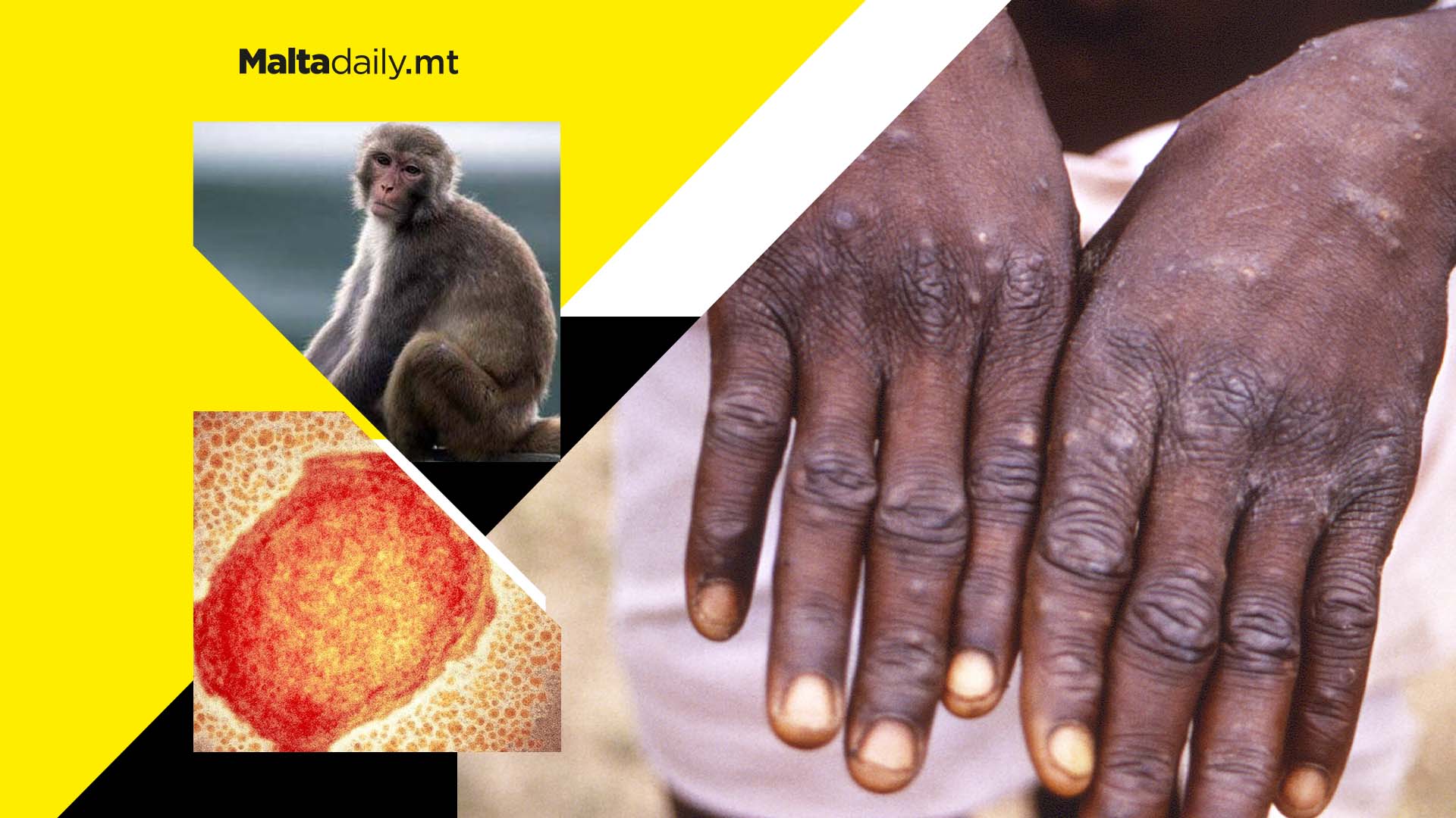 Monkeypox: What do we know about it?