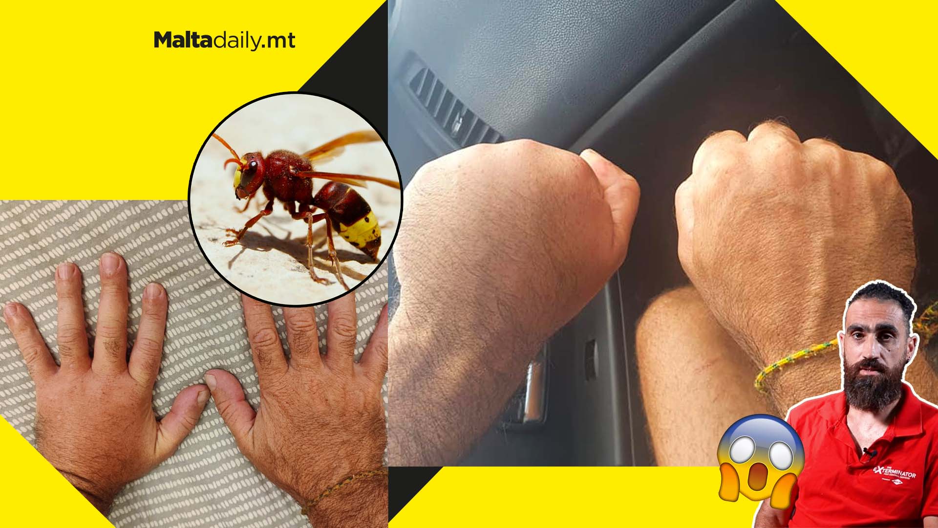 ‘Red Hot Needle’: Exterminator shows severe effects of hornet sting