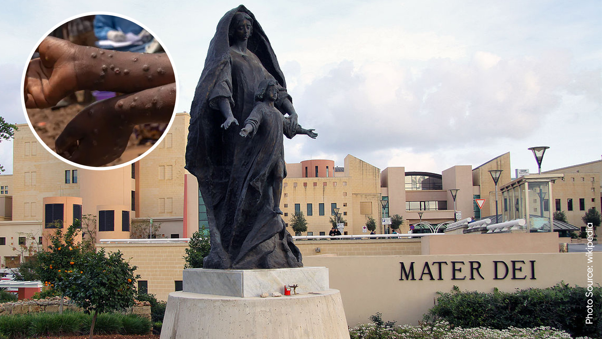 Malta Reports First Case of MPOX