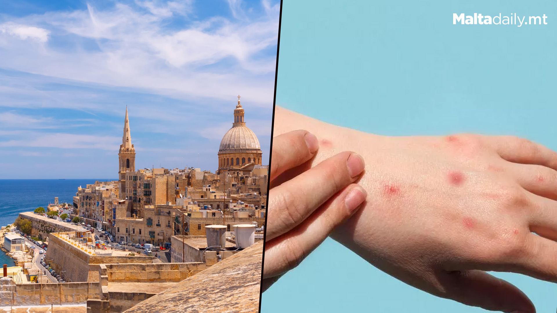 No Mpox Cases Registered In Malta, Health Ministry Says