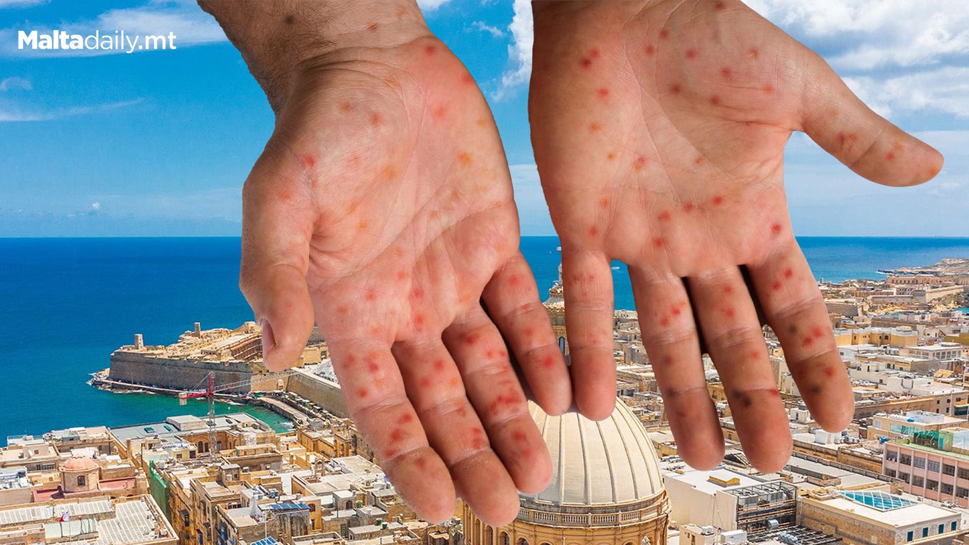 Second Case Of Mpox Detected In Malta